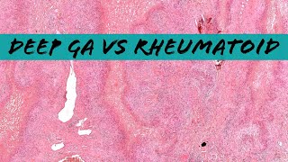 Deep Granuloma Annulare vs Rheumatoid Nodule palisaded necrobiotic granuloma pathology dermpath [upl. by Matthia777]