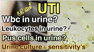 Wbcleukocytespus cellsin urine  Urine culture amp sensitivity  causes of Uti urduhindi [upl. by Ernesta198]