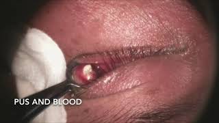 Incision and Drainage of Chalazion [upl. by Lamej]