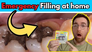 DIY Tooth filling Using Temporary filling material at home [upl. by Yenot418]