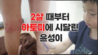 소아 아토피 치료 후 변화 우리 아이의 가려움 해결하세요 [upl. by Sanfourd]