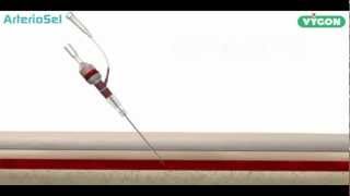 ArterioSel  Safe Simple Successful Arterial Cannulation [upl. by Otrebide]