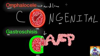 Omphalocele vs Gastroschisis Made Easy [upl. by Moishe552]