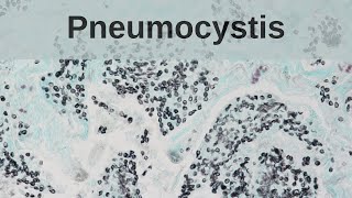 Pneumocystis Pneumonia  Pathology mini tutorial [upl. by Nnaarual93]