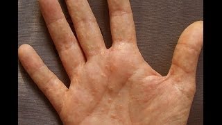 Dermatitis or Dyshidrosis How I Prevent Getting Painful And Unsightly Summer Hands [upl. by Kaufmann]