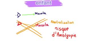 strabisme [upl. by Demona]