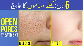 Khule Masam Band Karne Ka Tarika Open Pores Treatment  Open Pores Ka Ilaj Open Pores Home Remedy [upl. by Lednyk334]