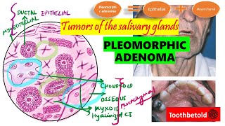 Pleomorphic Adenoma  Salivary gland tumors  DETAILED Textbook discussion Shafers  NEET MDSNBDE [upl. by Delphine796]