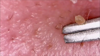 Worst Pops Cysts Zits Pimples amp Blackhead Popping [upl. by Eirrem]