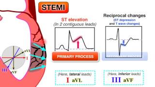 Ischemia 67  STEMI on ECG [upl. by Hebrew]