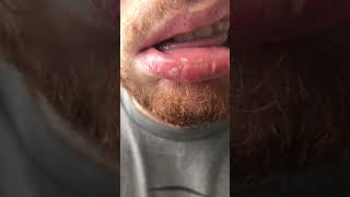 Exfoliative Cheilitis  Dovonex amp Elidel Treatment Results [upl. by Natanoy374]