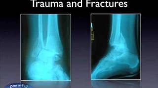 Treatment of Ankle Fractures [upl. by Ardnohs]