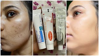 Dermatologist Recommended Best 3 Creams to remove Pimple Marks Acne Scars Dark Spots PIH [upl. by Ecinwahs]