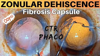 Zonular Dehiscence Noted during Phacoemulsification Management strategies  Dr Deepak Megur [upl. by Onivla]