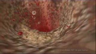 MEDICAL  How cholesterol clogs your arteries atherosclerosis [upl. by Grimonia]