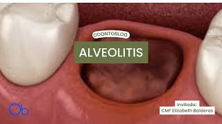 Alveolitis  qué es síntomas y tratamiento [upl. by Aliwt]