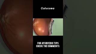 Glaucoma The Silent Thief of Sight shorts ayurveda treatment [upl. by Lucrece]