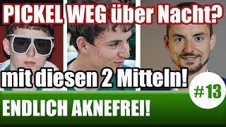 PICKEL WEG über Nacht mit diesen 2 Mitteln ENDLICH AKNEFREI 13 [upl. by Leiuqese]