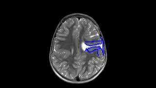 Bilateral schizencephaly  open and closed lip [upl. by Naejamron]