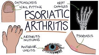 Psoriatic Arthritis [upl. by Fante]