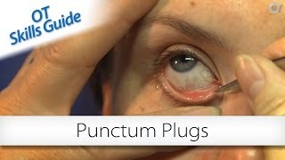 OT skills guide punctum plugs [upl. by Osnofledi]