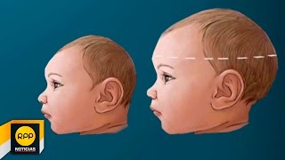 ¿Qué es la microcefalia│RPP [upl. by Ackerman6]