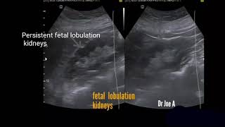 Persistent fetal lobulation kidney ultrasound video [upl. by Odnamra]