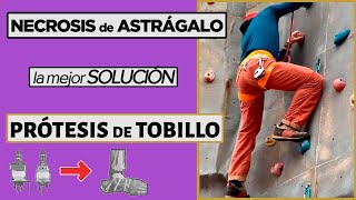 💪 NECROSIS de ASTRAGALO La mejor SOLUCIÓN una PRÓTESIS de TOBILLO [upl. by Kubiak20]