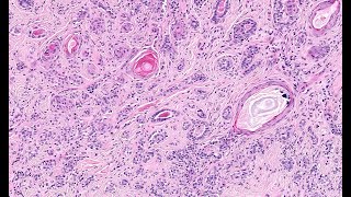 Microcystic adnexal carcinoma part 1 Phillip McKee Corey Georgesen Kikocom [upl. by Anomis839]