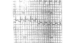 myocarditis pericarditis endocarditis [upl. by Hyrup]