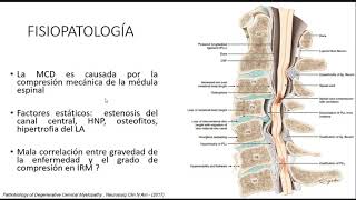 MIELOPATÍA CERVICAL ESPONDILOARTROSICA [upl. by Eelyam451]