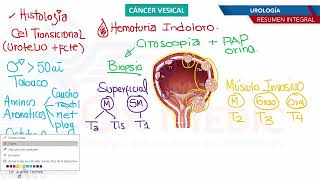 Urología  Cancer vesical [upl. by Larner]