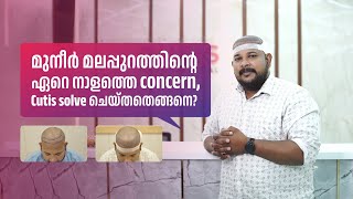 മുനീർ മലപ്പുറത്തിന്റെ ഏറെ നാളത്തെ concern Cutis solve ചെയ്തതെങ്ങനെ  MUNEER MALAPPURAM [upl. by Einahpetse639]