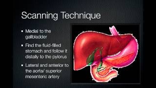 pyloric stenosis [upl. by Brodie401]