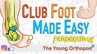 CLUB FOOT Pathoanatomy Made Easy  The Young Orthopod [upl. by Annmarie]