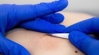 How to get rid of Skin Tags  Advanced electrolysis [upl. by Amapuna400]