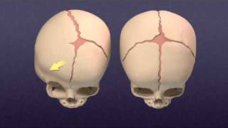 Craniosynostosis  Mayo Clinic [upl. by Goldy255]