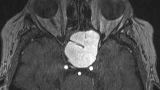 Sphenoid Mucocele [upl. by Hollyanne]