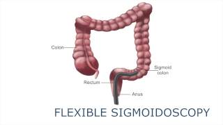 Flexible sigmoidoscopy [upl. by Favien]