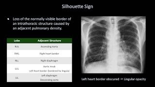 How to Interpret a Chest XRay Lesson 8  Focal Lung Processes [upl. by Guinna]