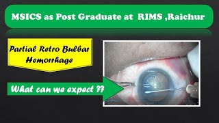 MSICS Cataract Surgery  challenging Cortical aspiration  RIMS  Raichur  Dr Rakesh Koli [upl. by Assirialc]