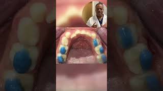 How Long Does It Take to See a Difference with Braces 6 months Transformation  Reverse Headgear [upl. by Aifoz]