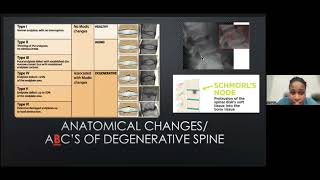 ThoracoLumbar Spine Degenerative Disease [upl. by Ahsiral]