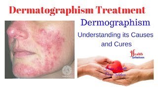 Dermatographism Treatment  Dermographism  Understanding its Causes and Cures [upl. by Nunci]