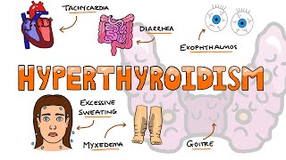 Hyperthyroidism Signs and Symptoms Mnemonic  SWEATING [upl. by Idarb]