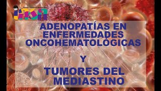 Adenopatías en Enfermedades Oncohematológicas Y Tumores del Mediastino  Telecapacitación INSN [upl. by Naujat623]