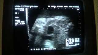 CYST with echogenic area in FETAL lower abdomen [upl. by Mckay]