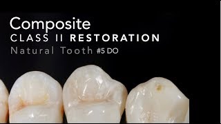 Class II Composite Restoration  5 DO Natural Tooth [upl. by Arabeila225]