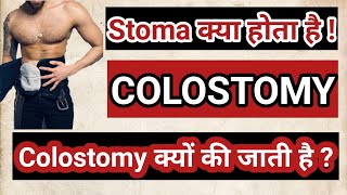 colostomy  colostomy care in hindi  colostomy bag  colostomy care  stoma bag [upl. by Tichonn778]