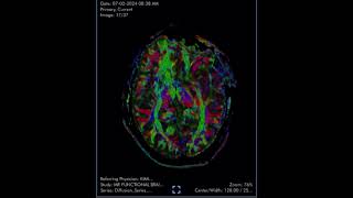 Diffusion tensor imaging DTI is an MRI technique that analyzes the anatomy of nerve cells [upl. by Anchie]